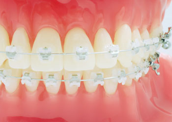 目立たず、痛みが少なく、早く歯が動く矯正治療