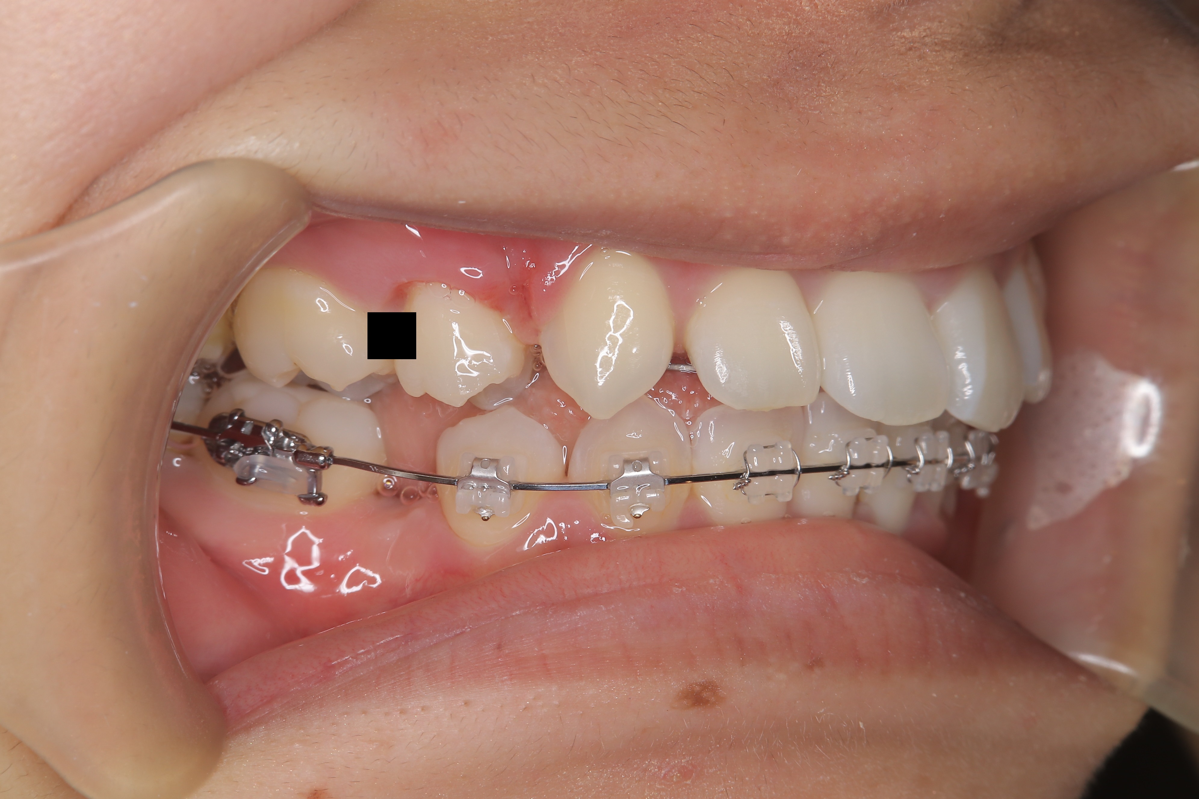 歯科矯正の治療経過 こじま矯正歯科クリニック